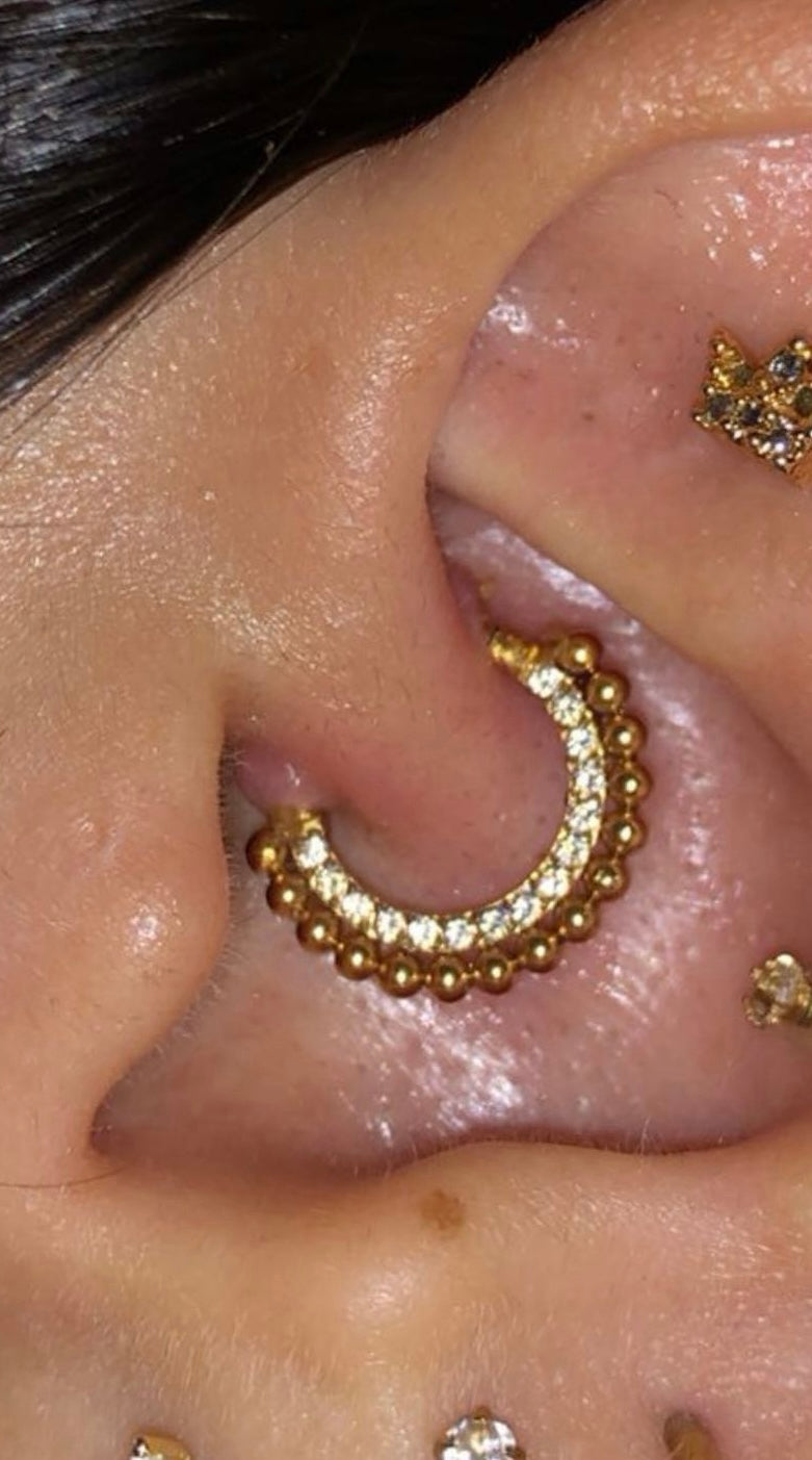 A piercing with an irritation bump